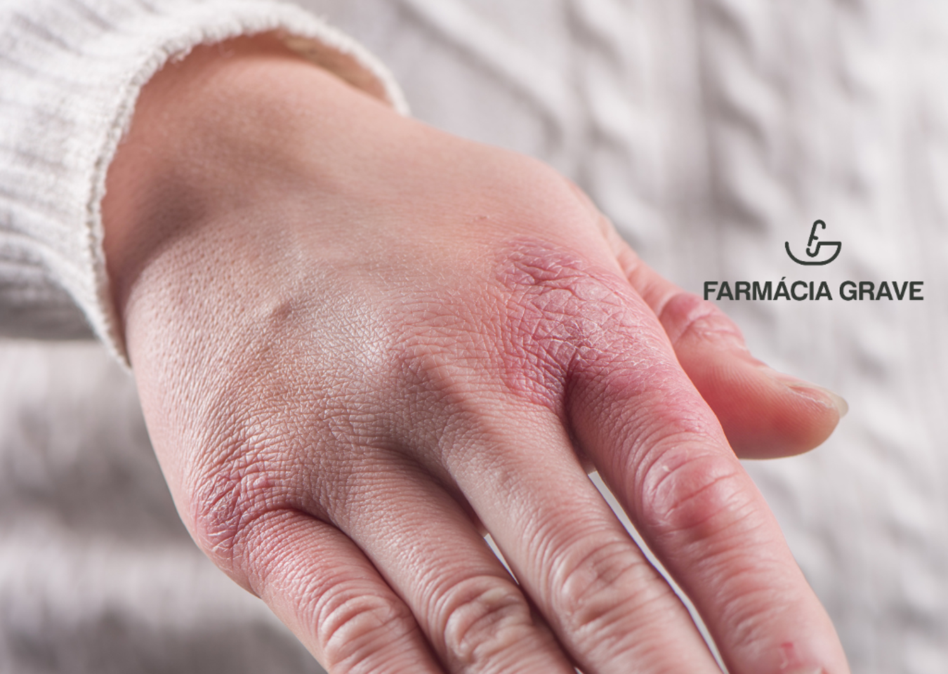 Frieiras: aprenda a prevenir!